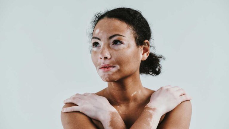 Vitiligo: Causas, Sintomas e Tratamentos