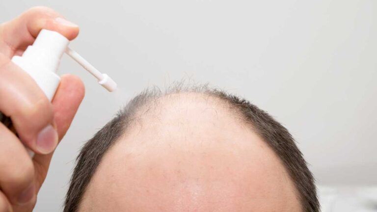 Finasterida: qual a diferença entre ela e o minoxidil